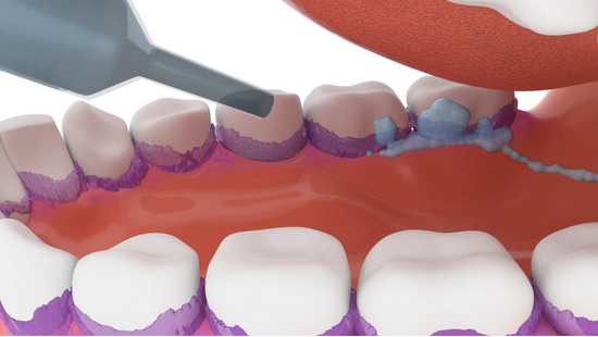 PAVM: Formation et prévention des Pneumopathies Acquises sous Ventilation Mécanique